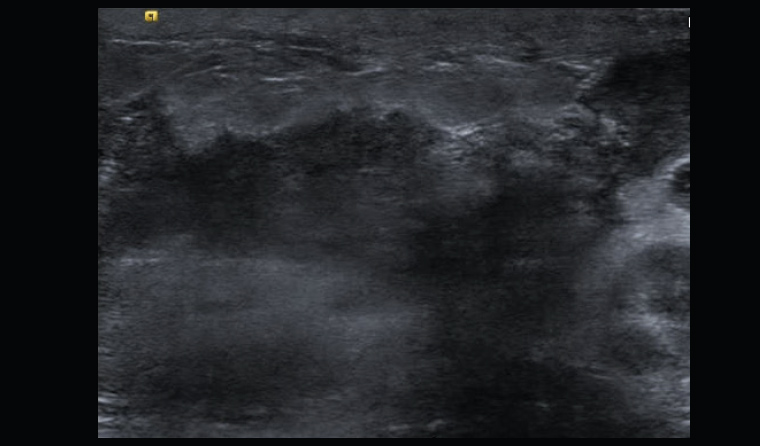 Figure 2. Ultrasound showing skin thickening and focal hypoechoic area suggesting abscess formation.
