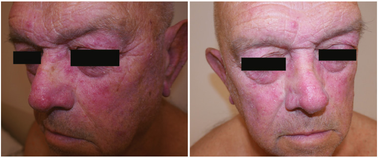 Figure 1. Erythematous facial rash on a male patient.