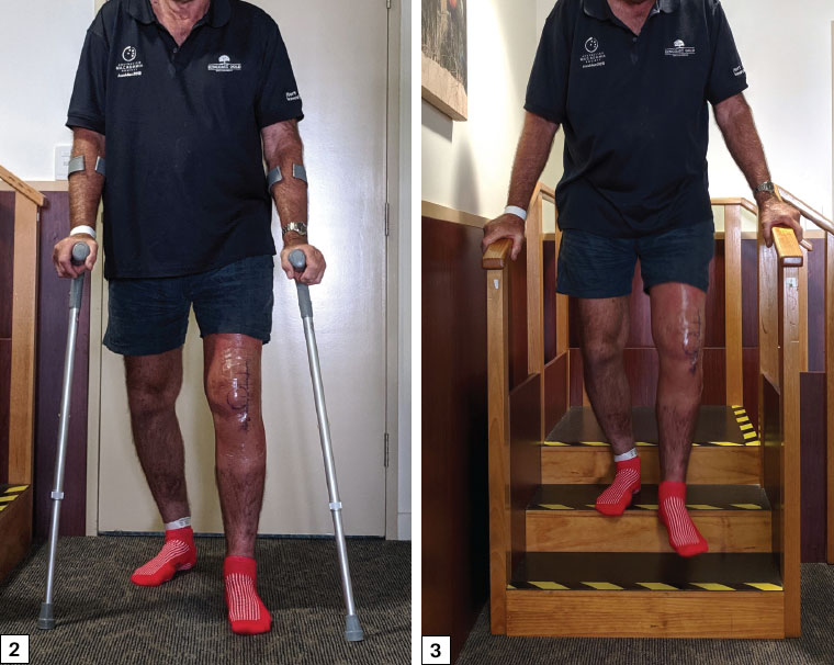 Figure 2. Gait retraining on the first postoperative day following total knee replacement surgery. Figure 3. Stair climb practice on the first postoperative day following total knee replacement surgery