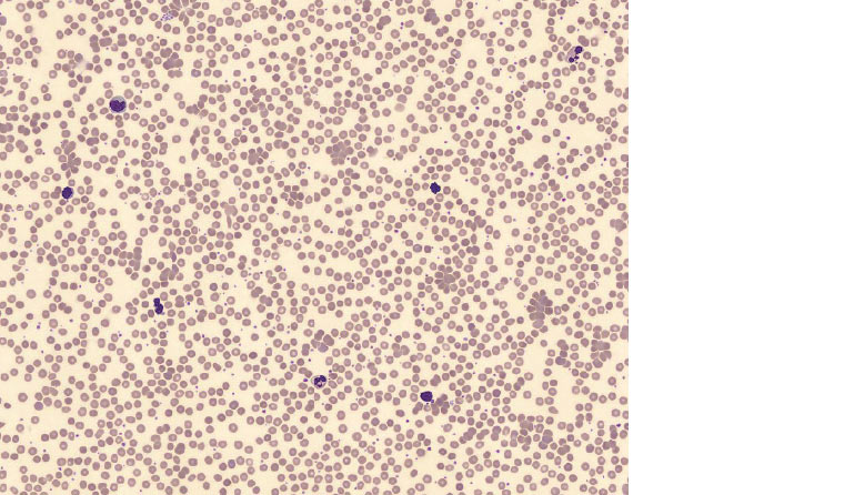 AJGP-11-2019-Clinical-Adeyemi-Red-Cell-Agglutination-Fig-1.jpg