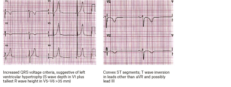 Figure 2. Typical electrocardiographic findings for the athlete.