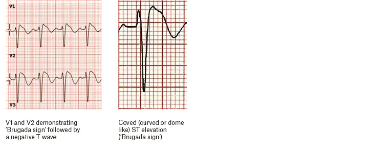 Figure 4. Electrocardiography findings for Brugada syndrome.