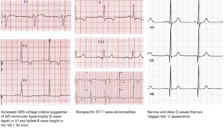 Figure 5. Some characteristic findings for hypertrophic cardiomyopathy on electrocardiography.