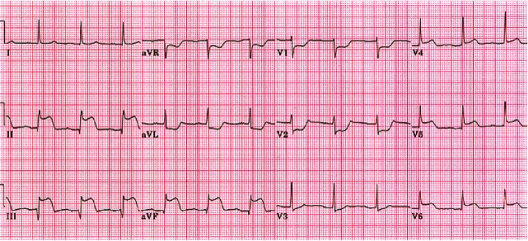 Figure 6. Example of electrocardiogram during an acute myocardial infarction.