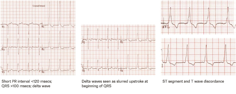 Figure 7. Possible electrocardiographic findings for Wolff–Parkinson–White syndrome.