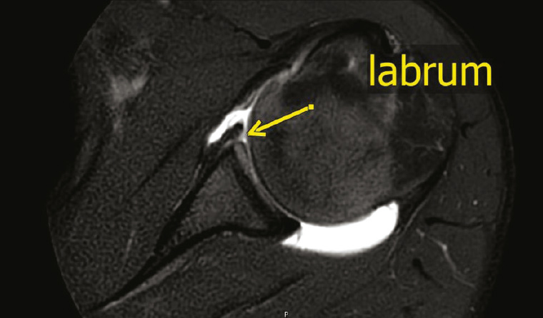 Figure 1. Glenoid labrum can be seen on a magnetic resonance arthrogram of the shoulder.