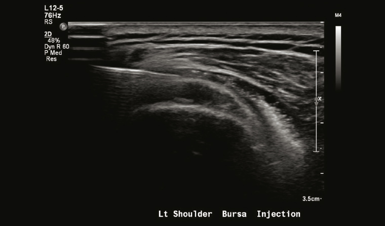 Figure 2. Ultrasound-guided injection into thickened subacromial bursa.