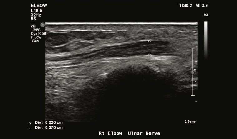 Figure 4. Thickened ulnar nerve in the elbow. Ultrasound-guided injection into the perineural space can be performed for symptomatic relief and to establish a diagnosis of ulnar neuritis.