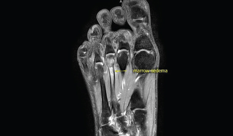 Figure 5. Stress fractures can be better shown on magnetic resonance imaging, especially those inconspicuous on X-ray or computed tomography scans.