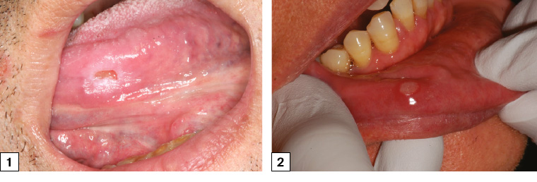 Figure 1. Symptomatic traumatic ulceration of the left mid-ventral tongue associated with a sharp left lower molar. The ulcer has flat edges and is surrounded by an area of frictional keratosis. The ulcer was soft on palpation. Figure 2. Minor aphthous ulceration of the lower right labial mucosa with typical erythematous hallow and yellow base.
