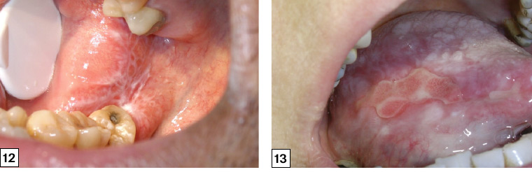 Figure 12. ‘Wickham’s striae’ of oral lichen planus on the right buccal mucosa extending across the retromolar pad presenting as a lace- or net-like pattern of keratotic lines on a faint erythematous background. Figure 13. Erosive oral lichen planus presenting as a large ulceration on the right lateral tongue. Ulceration is often persistent and must be differentiated from an oral malignancy.