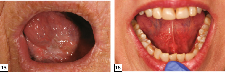 Figure 15. Leukoplakia of the ventral tongue. Incisional biopsy showed severe dysplasia, and the lesion was subsequently completely excised. Figure 16. Erythroplakia of the bilateral floor of the mouth presenting as a diffuse, painless, ‘velvety’ red patch. This lesion harboured severe dysplasia.