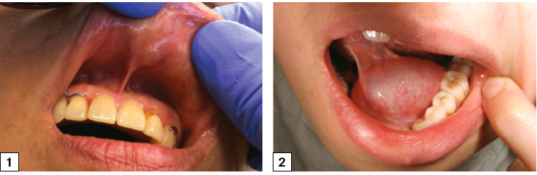 Figure 1. Mucocoele of the upper lip with dome-shaped swelling and bluish tinge of saliva visible underneath the normal-appearing mucosa. Figure 2. A ranula – a mucocele of the sublingual gland.