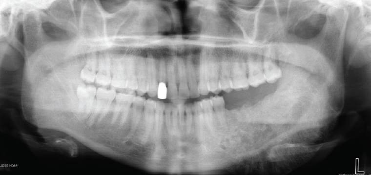 Figure 17. Orthopantomogram showing a left mandible osteosarcoma – a mixed lucent–opaque lesion extending from the lower left first premolar to involve the left ramus of the mandible with classic ‘sunburst’ appearance.