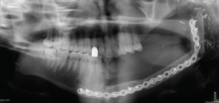 AJGP-09-2020-Focus-Wong-Common-Swelling-Oral-Cavity-Fig-18.jpg