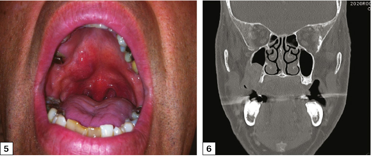 Figure 5. Right palatal swelling at the junction of the hard and soft palate. The lesion was firm on palpation. The overlying mucosa was not ulcerated. The diagnosis was mucoepidermoid carcinoma of the right palate, and treatment involved surgical excision (maxillectomy) and free flap reconstruction. Figure 6. Coronal computed tomography scan showing extension of a right palatal tumour into the right maxillary sinus but not extending to involve the right orbital floor.