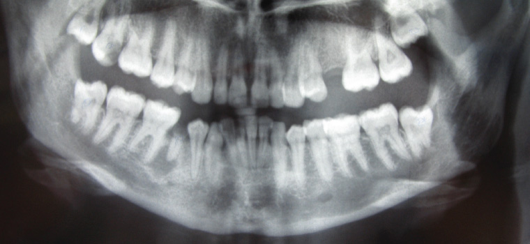 Figure 9. Orthopantomogram showing a lower right second premolar tooth with a grossly carious crown and a well-defined periapical radiolucency characteristic of a periapical (radicular) cyst arising from the non-vital tooth.
