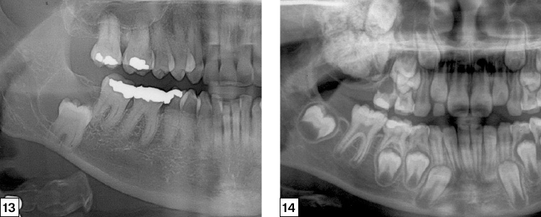 Figure 13. Right segment of an orthopantomogram illustrating a cyst associated with the impacted right lower third molar (48) Figure 14. Right segment of an orthopantomogram illustrating a radio-opaque maxillary lesion.
