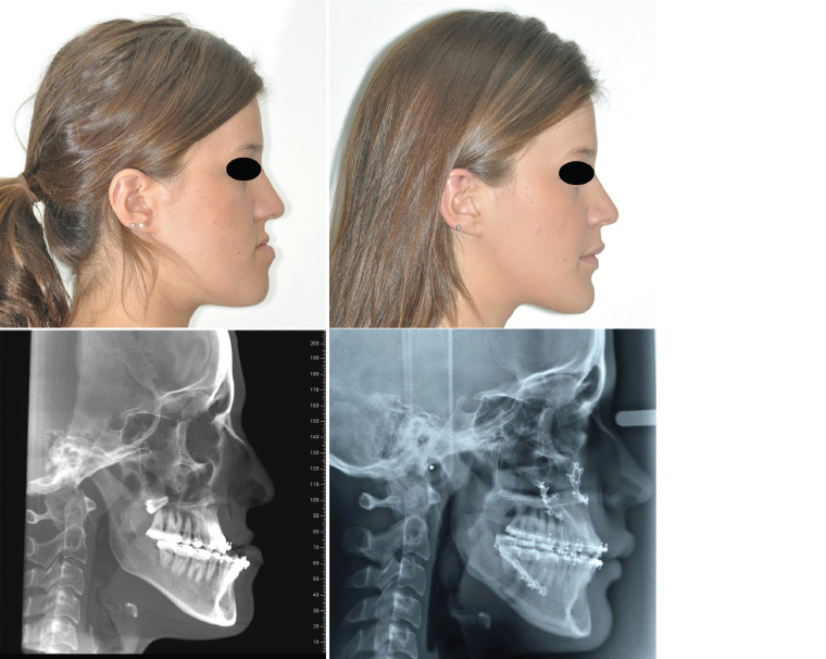 Figure 3. Small maxilla and large mandible treated by maxillary advancement and mandibular setback.
