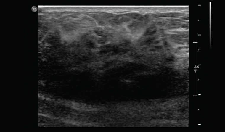 Figure 1. Ultrasound showing non-specific changes of altered echotexture and shadowing.