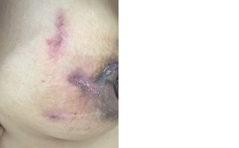 Figure 4. Healed areas of granulomatous mastitis. Significant scarring has resulted.