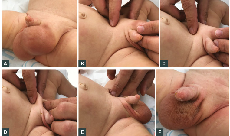 Figure 1. Clinical reduction of an inguinal hernia.