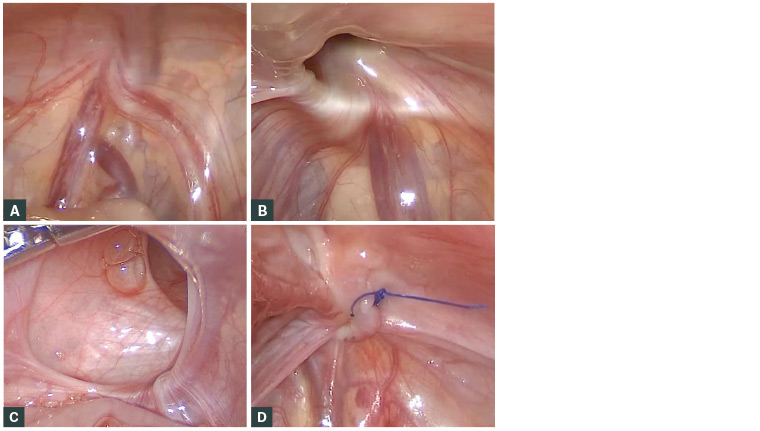 Figure 3. Operative laparoscopic images of the internal ring and inguinal hernias in male infants.