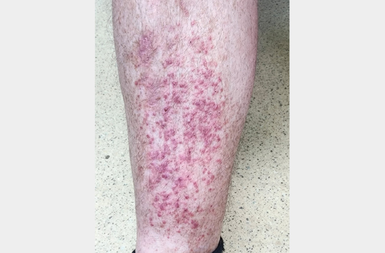 Figure 1. Pruritic papules on the right leg.
