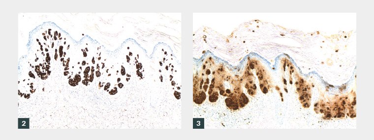 Figure 2. Cytokeratin 7 positive staining  Figure 3. Carcinoembryonic antigen and epithelial membrane antigen positive cells and cytokeratin 20 negative cells throughout the epidermis in a pagetoid distribution