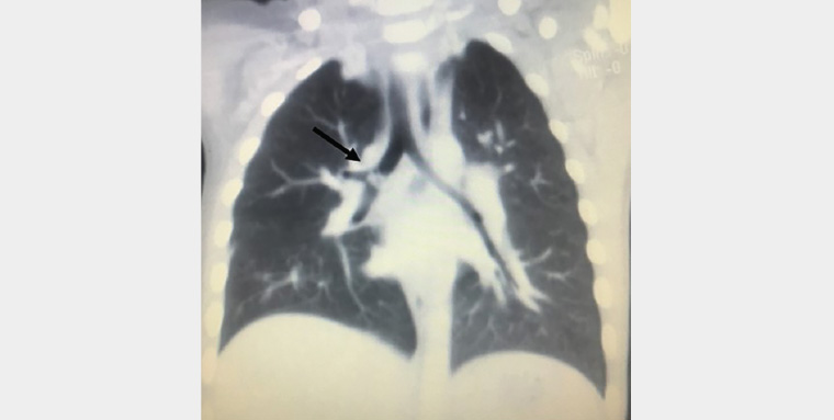 Figure 2. High-resolution computed tomography of the thorax showing an irregular lesion at the distal right main bronchus (arrow)