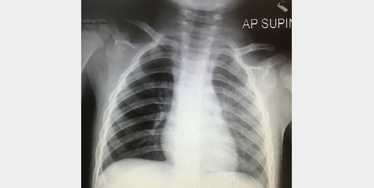 Figure 1. Chest X-ray of patient