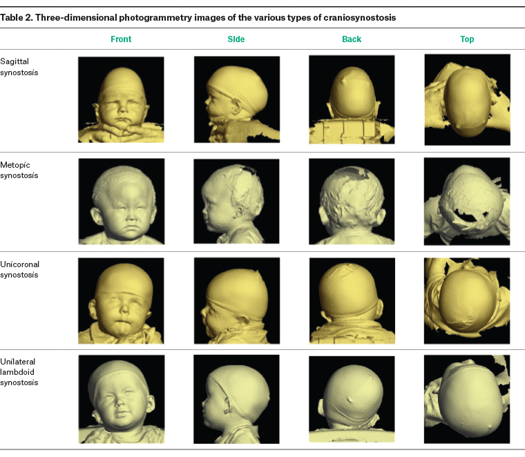 Table 2. Three dimensional photogrammetry images of the various types of craniosynostosis