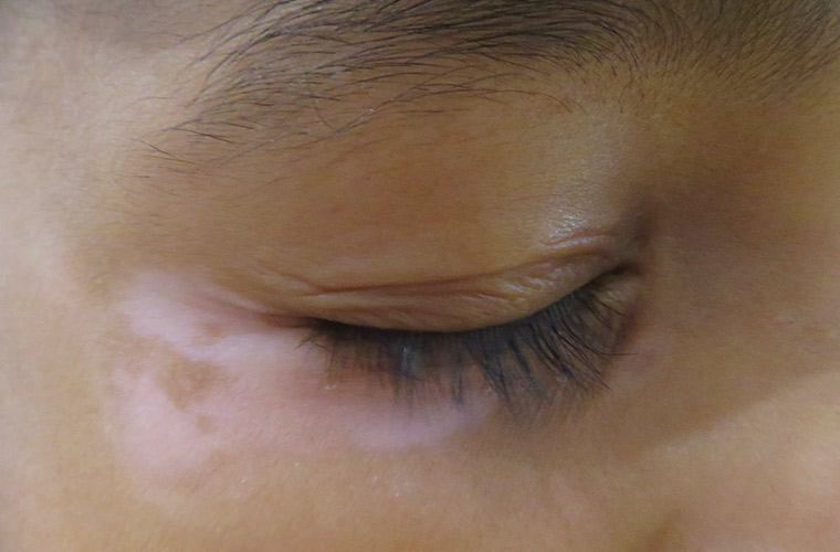 Figure 2. Vitiligo lesions present on the eyelid and upper malar region.