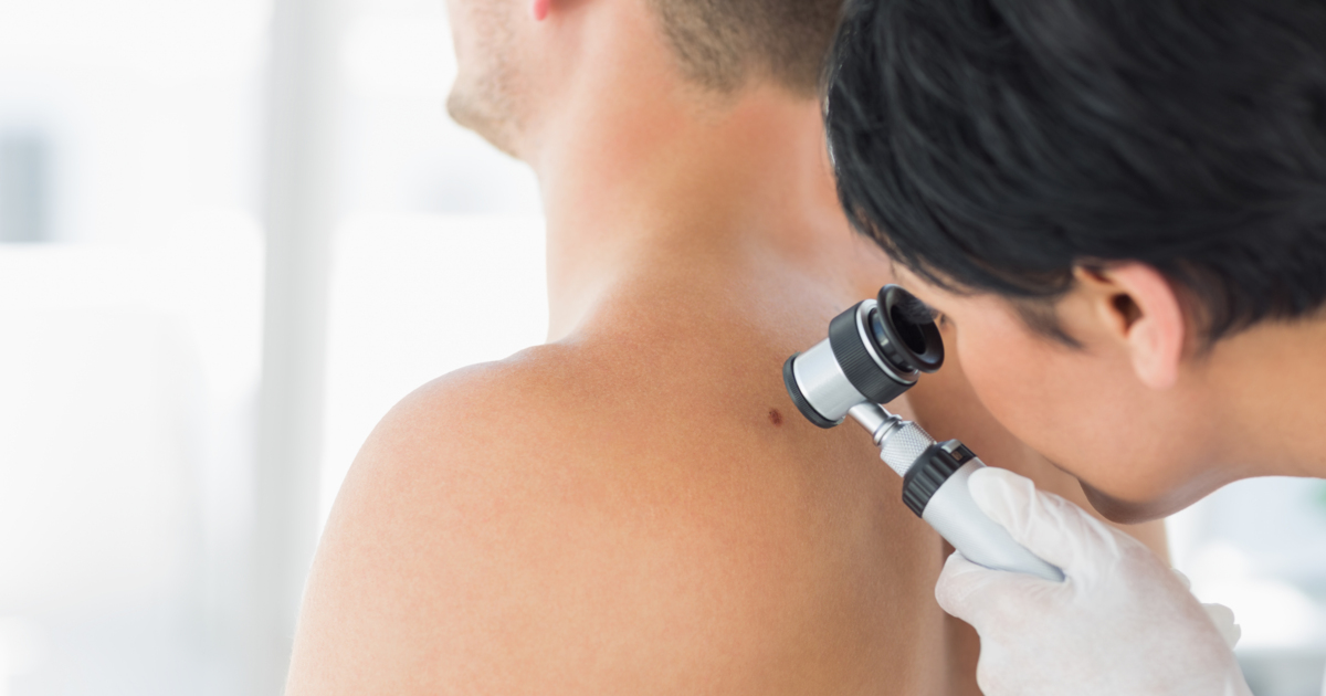 newsGP - Optimism around ‘personalised’ melanoma treatment