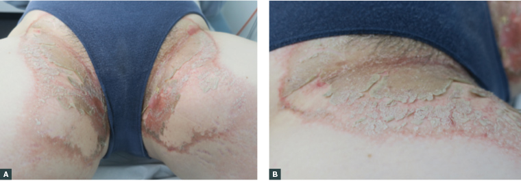 A scaly and desquamating rash to the groin with a prominent erythematous margin
