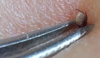 Removing tick from human skin
