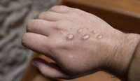 Australia reported more than 1400 cases of mpox in 2024, with the majority being locally acquired.