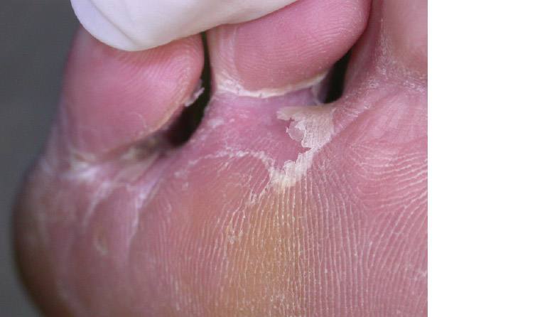 AJGP-10-2019-Clinical-Kovitwanichkanont-Superficial-Fungal-Infections-Fig-1.jpg