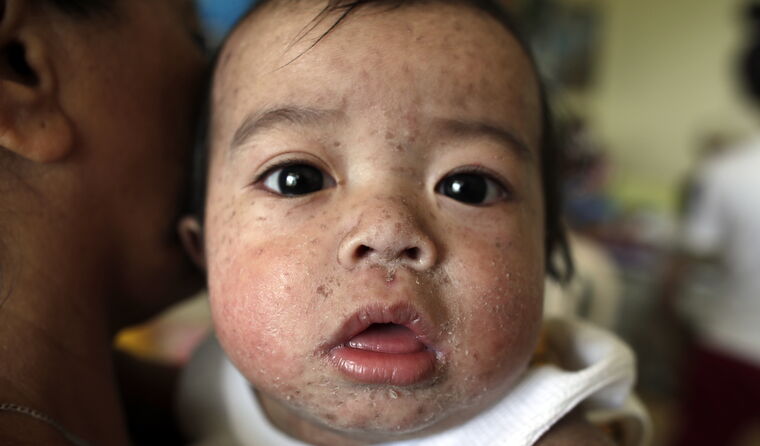 Infant with measles