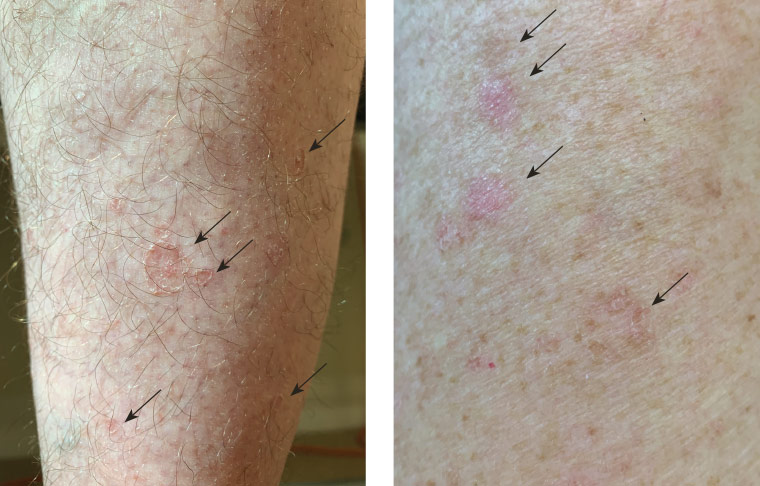 AJGP-11-2019-Clinical-Brand-Pre-Cancerous-Skin-Lesion-Fig-1.jpg