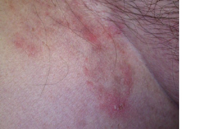 AJGP-10-2019-Clinical-Kovitwanichkanont-Superficial-Fungal-Infections-Fig-5.jpg