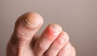 Toes with chilblains