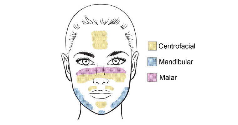 Figure 2. Clinical patterns of facial melasma
