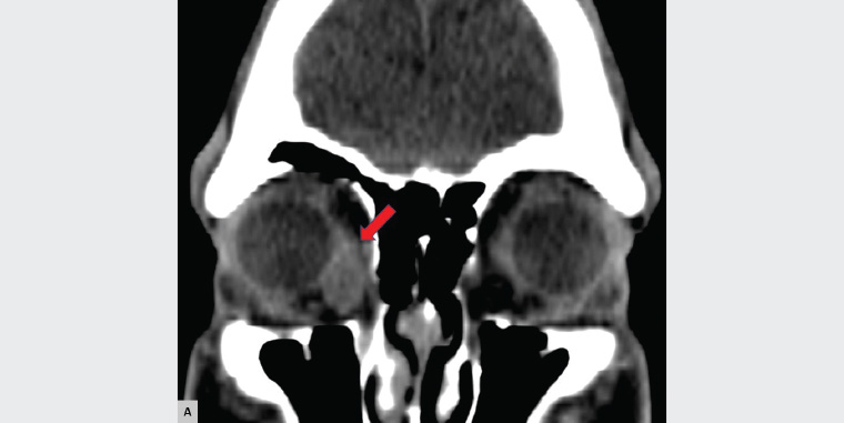 Figure 2. Coronal non–contrast enhanced computed tomography scan showing a right orbital mass (red arrow) with well-defined borders located mid-inferiorly to the medial rectus muscle and slight superolateral globe displacement