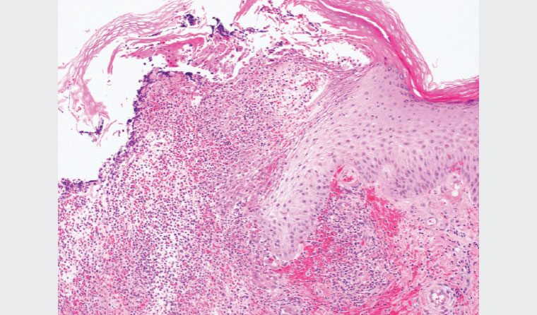 Figure 2. Micrograph involving the ulcer edge showing necrosis and a prominent inflammatory infiltrate of neutrophils