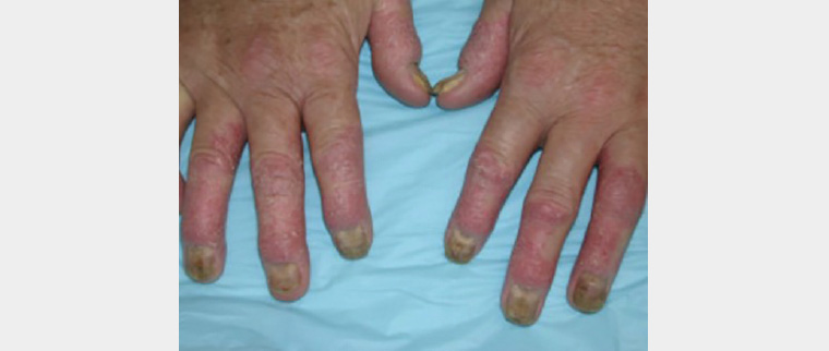 Figure 3. Psoriatic arthritis of the hands showing nail dystrophy and skin psoriasis