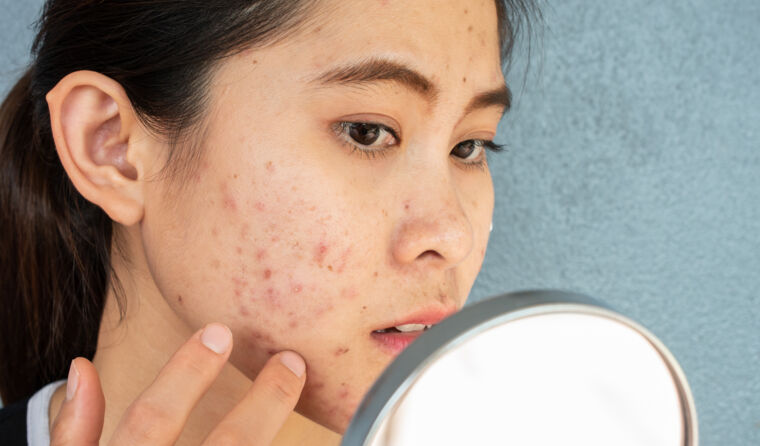 Young woman with acne