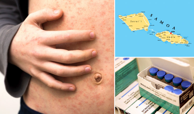 Measles, vaccine, Samoa