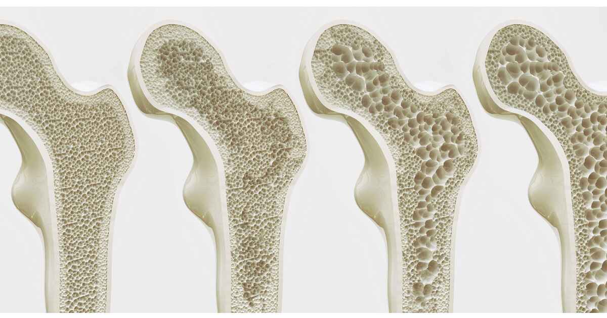 RACGP - A fracture every 30 seconds: Bone health laid bare