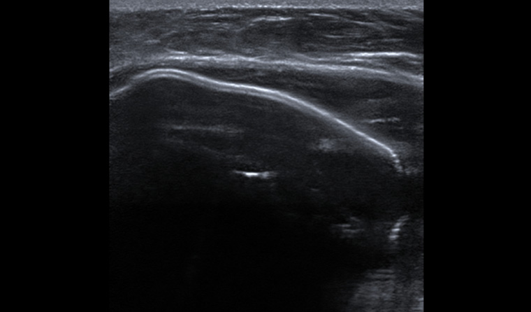 Figure 1. Ultrasonography of the right reconstructed breast